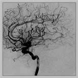 Cerebral - Angio 2